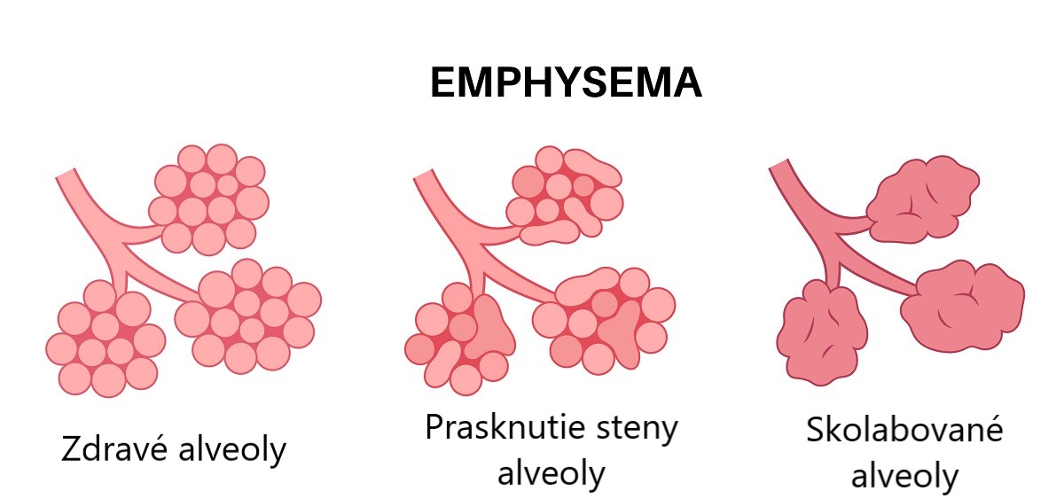 Ilustrace poškozených alveolů při plicním emfyzému. Zdrojové foto: Getty Images Plicní emfyzém, poškození alveolů